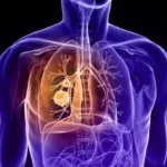 Uno studio italiano ha evidenziato il ruolo di un gene nella genesi dei tumori polmonari